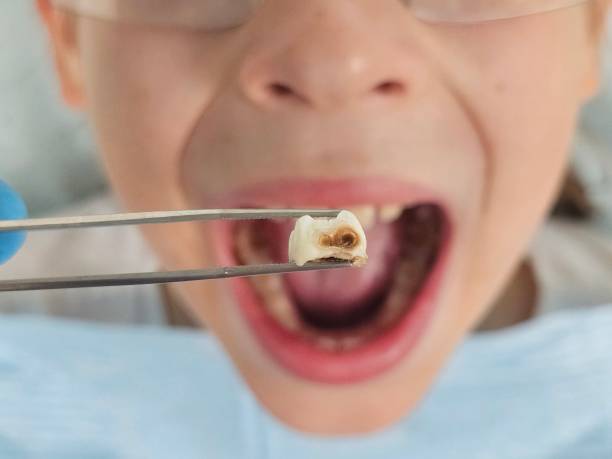 Best Knocked-Out Tooth (Avulsed Tooth) Treatment in Arcadia, SC